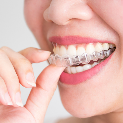 invisalign placement